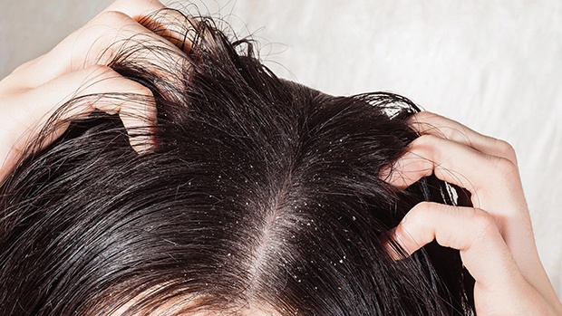 Tóc bị bết dính sau khi gội đầu - Lý do và cách khắc phục