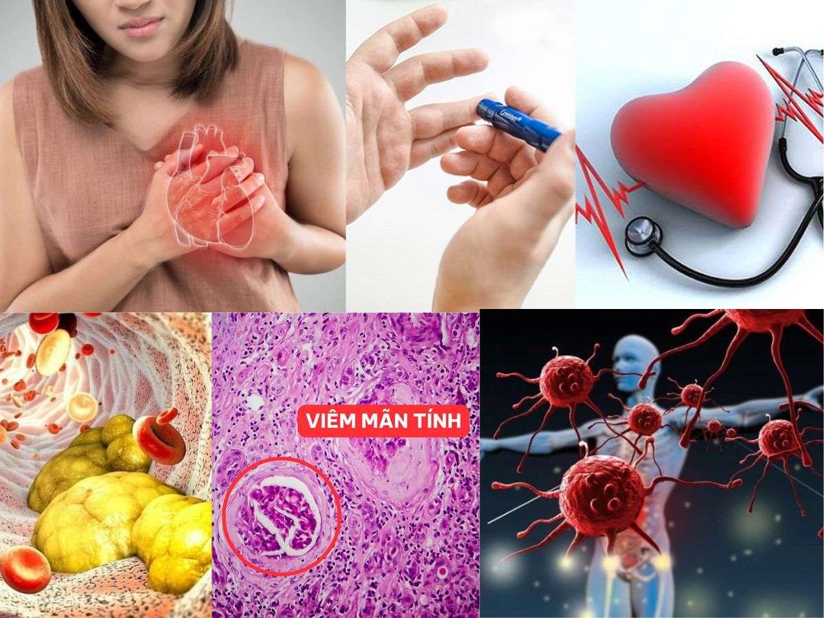 Mỡ bụng dư thừa làm tăng nguy cơ mắc bệnh tim, tiểu đường, ung thư và ảnh hưởng đến chất lượng sống