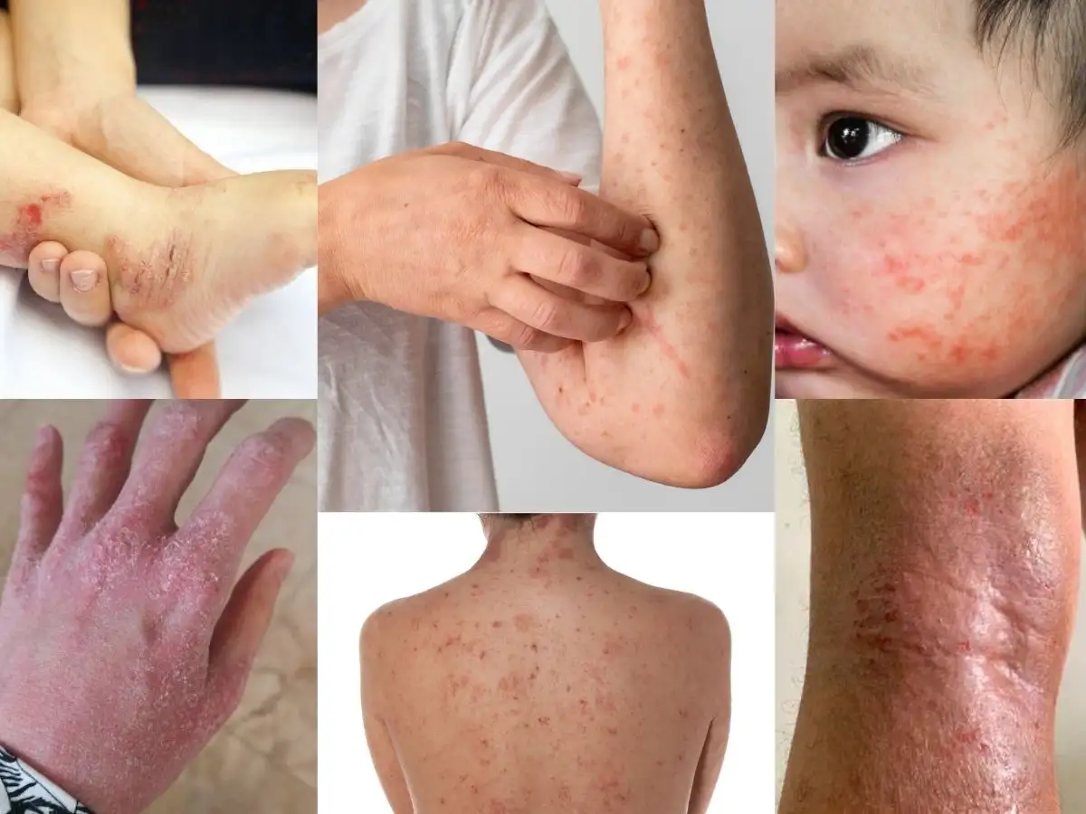 Viêm da cơ địa là gì? Nguyên nhân, biểu hiện 