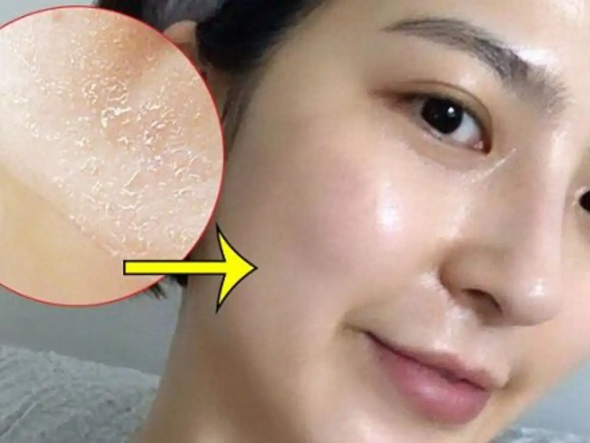 Loại peel này phù hợp với những vấn đề da nhẹ như da xỉn màu, mụn nhẹ