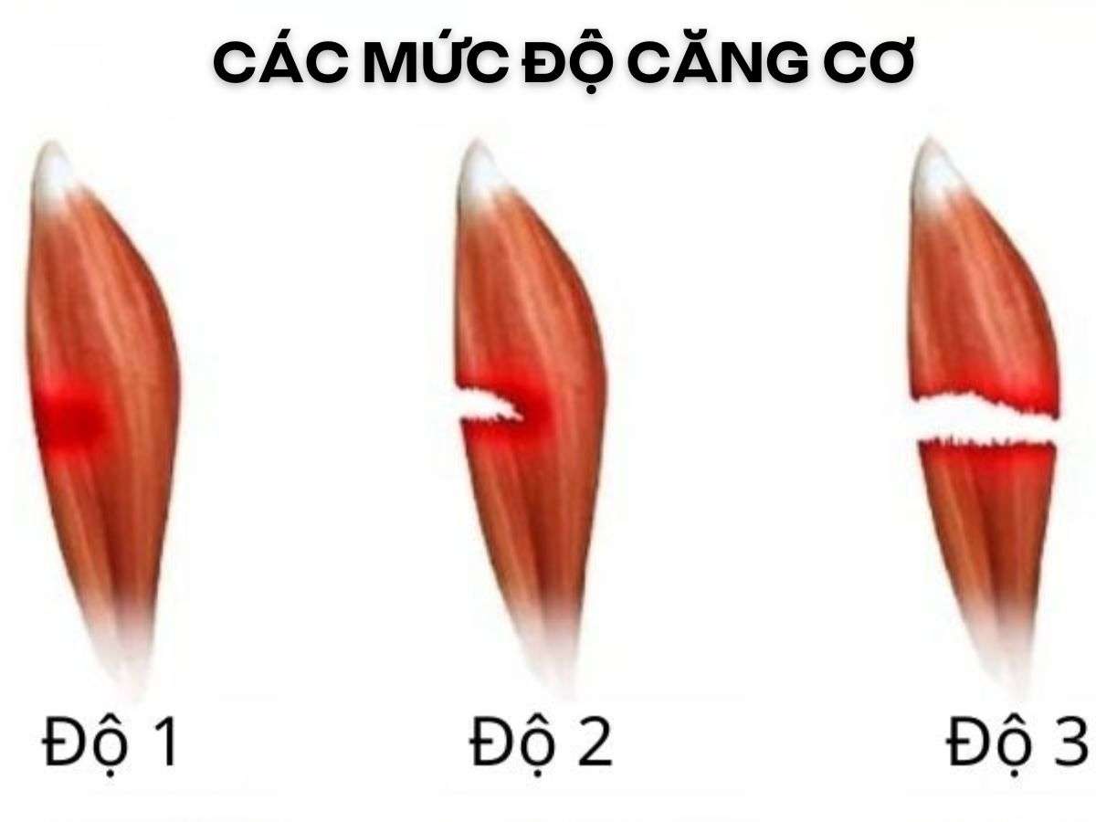 Căng cơ theo 3 mức độ nhẹ, vừa và nặng, dựa trên mức tổn thương sợi cơ