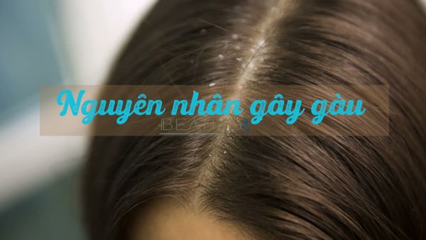 Nguyên nhân tóc bị gàu mảng và cách phòng ngừa hiệu quả  Nhà thuốc FPT  Long Châu