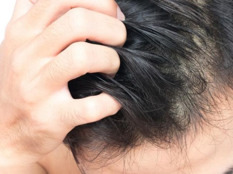 Bị nấm da đầu có nên gội đầu thường xuyên