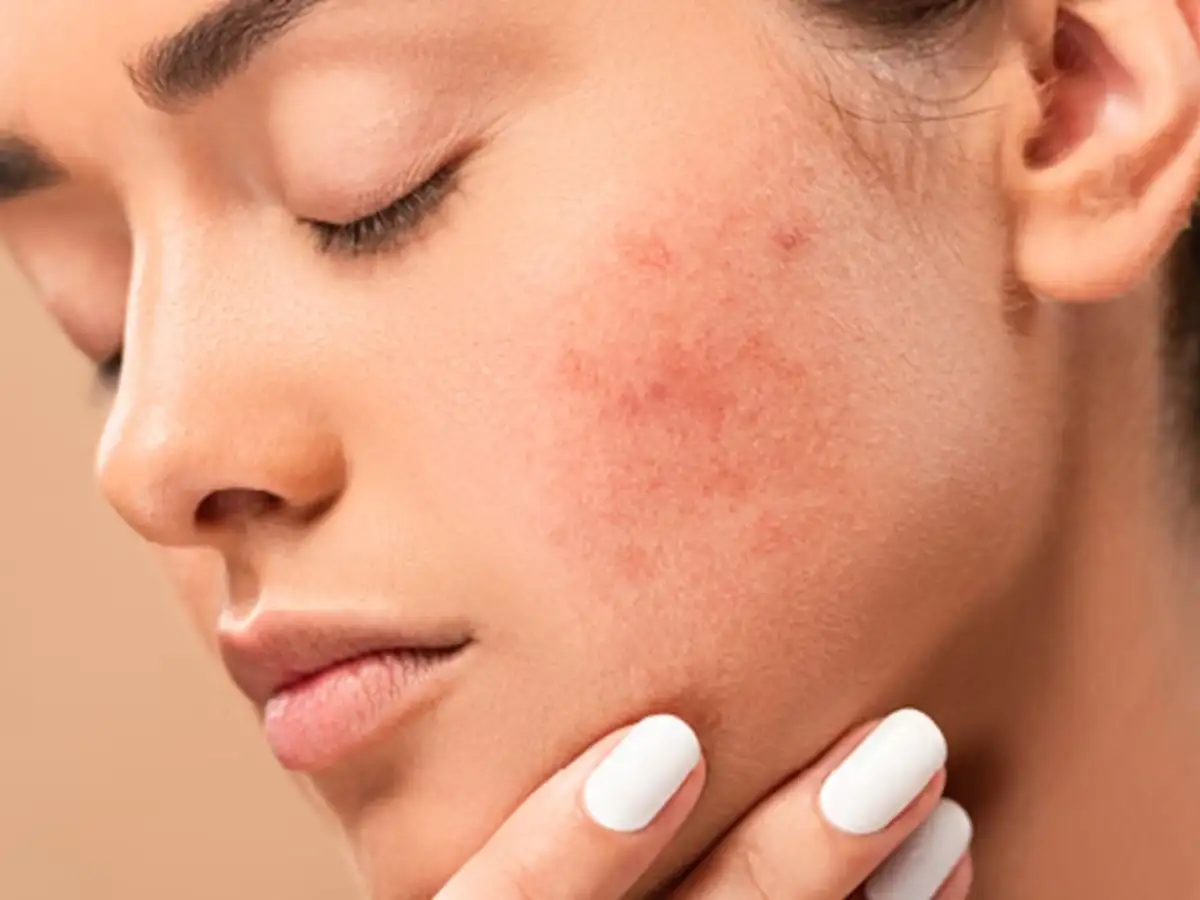 Hiện tượng kích ứng da khi mới dùng serum Vitamin C 