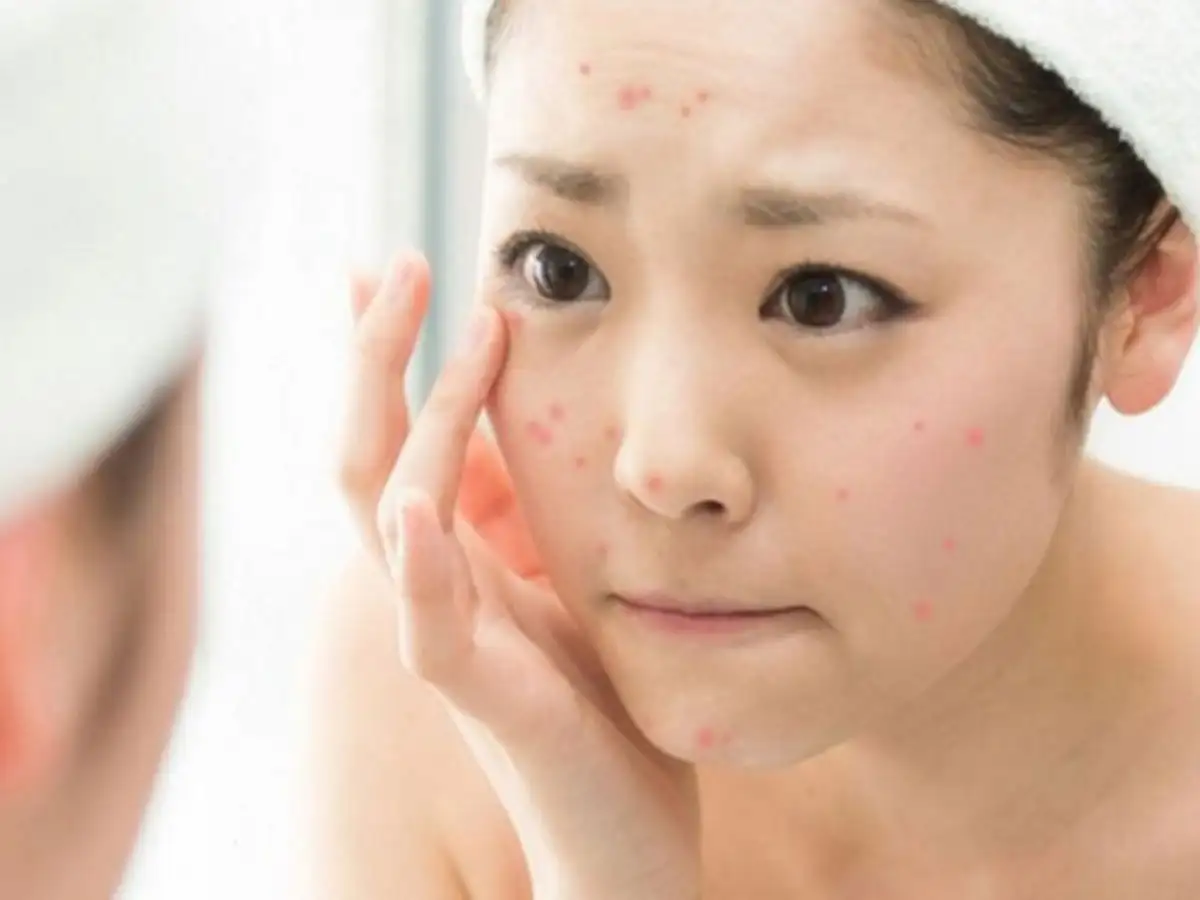 Tại sao chăm sóc da sau nặn mụn lại quan trọng đến thế?