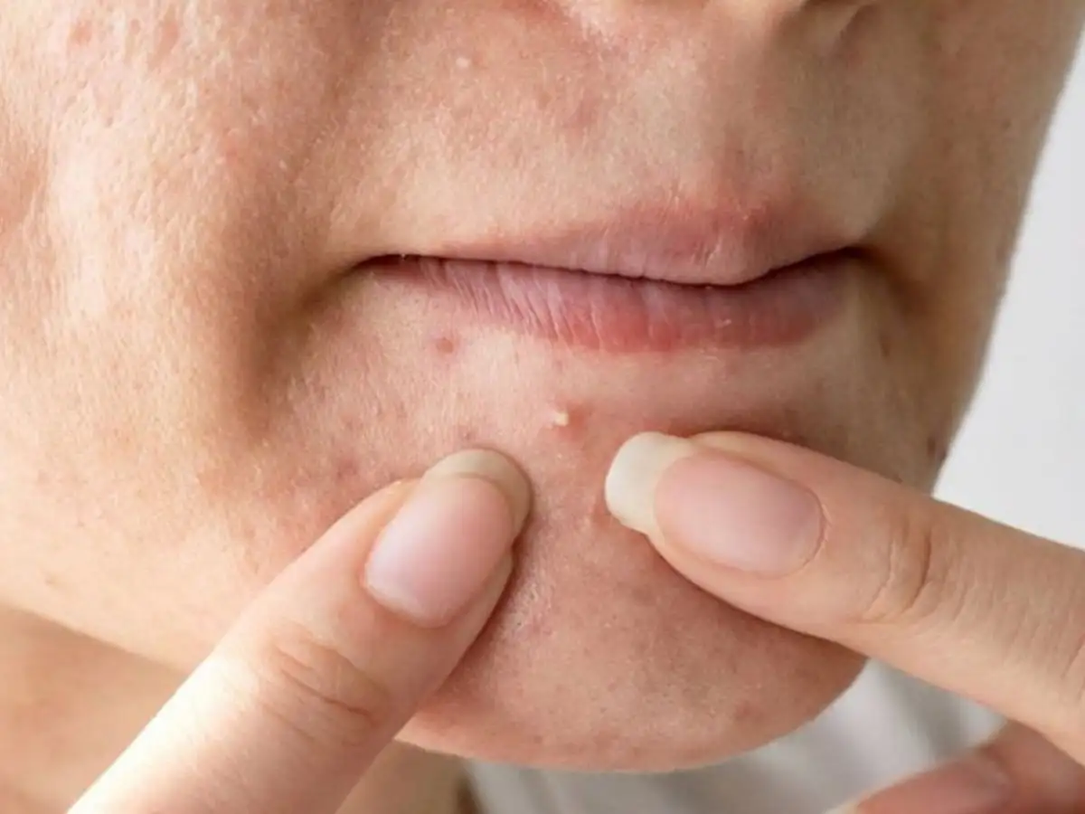 Giai đoạn ngay sau khi nặn mụn