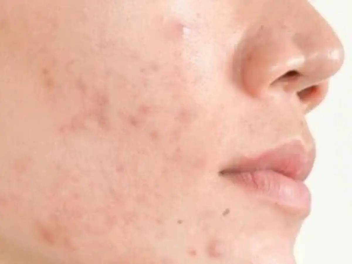 Giai đoạn phục hồi ban đầu
