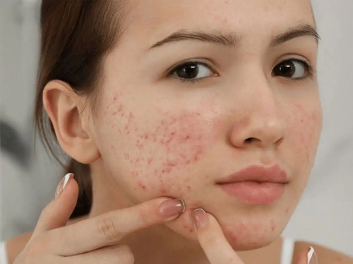 Những điều cần tuyệt đối tránh làm sau khi nặn mụn