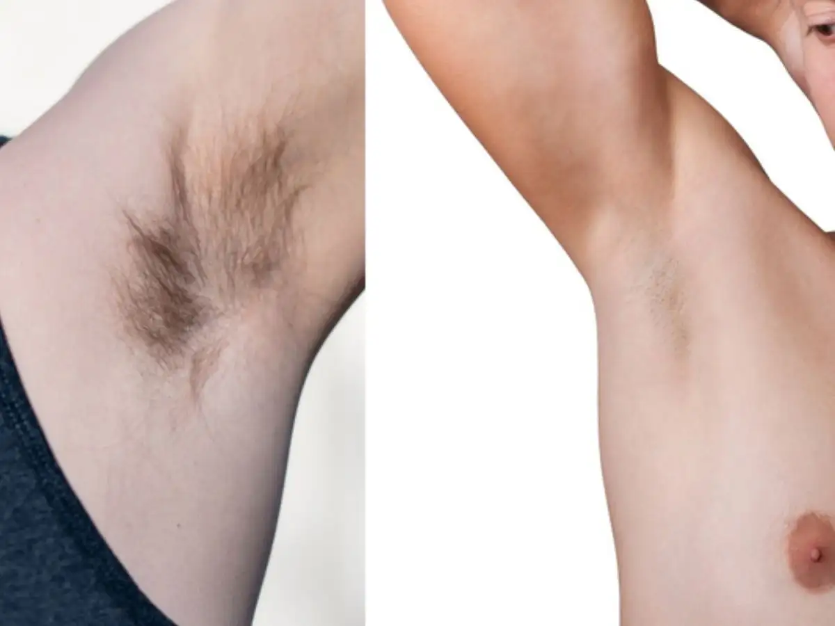 Các Cách Khác Để Xử Lý Lông Nách Nam