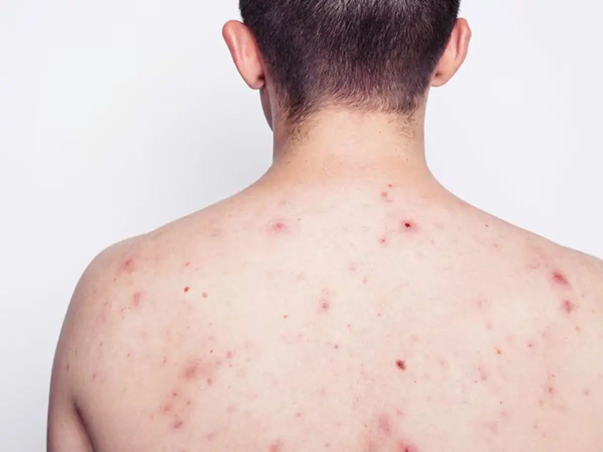 Vì sao mụn lưng xuất hiện ở nam giới?
