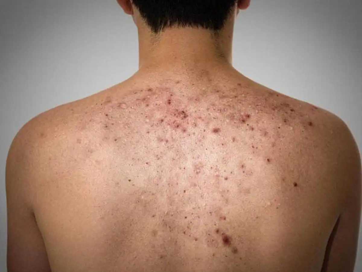 Tránh xa các chất làm mụn năng hơn