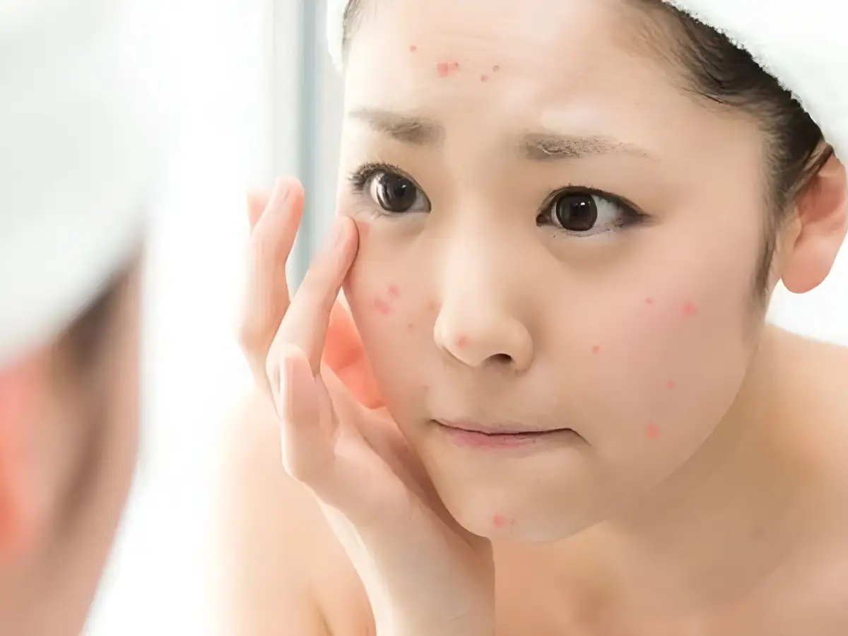 Những Nguyên Tắc Vàng Không Thể Bỏ Qua Khi Skincare Da Dầu Mụn