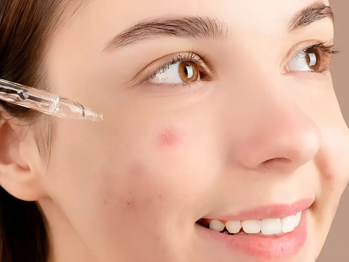Có cần dùng serum cho da dầu mụn không?