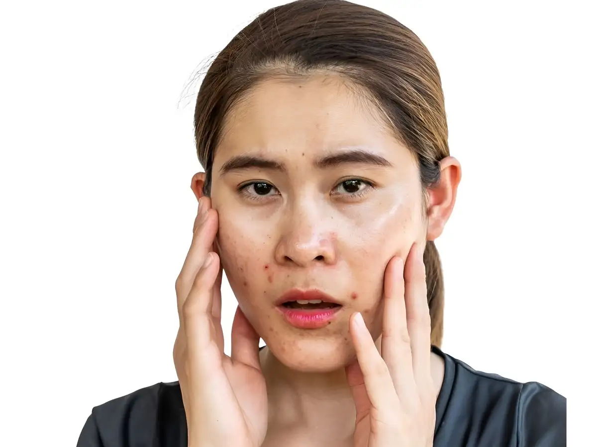 Skincare cho da dầu mụn bao lâu thì có hiệu quả?