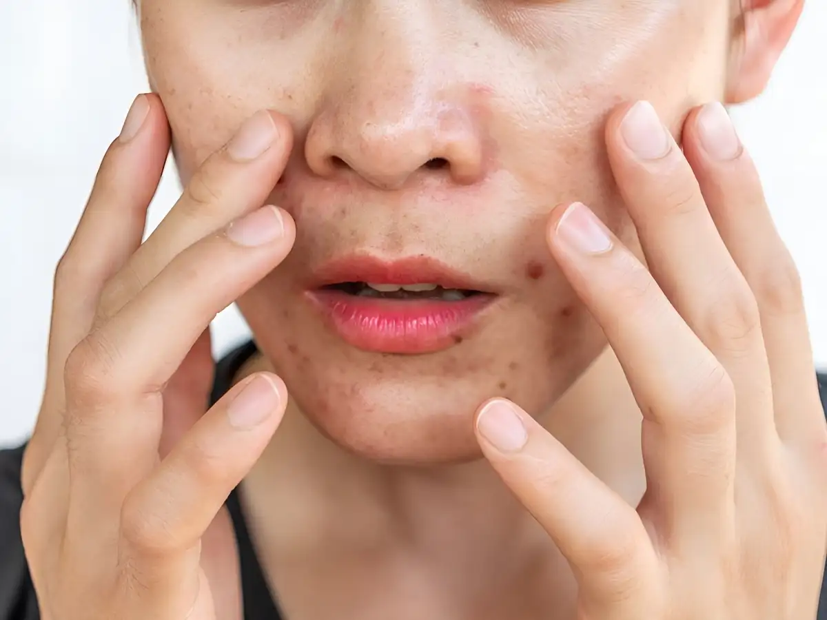 Nguyên nhân gây da dầu mụn rất đa dạng
