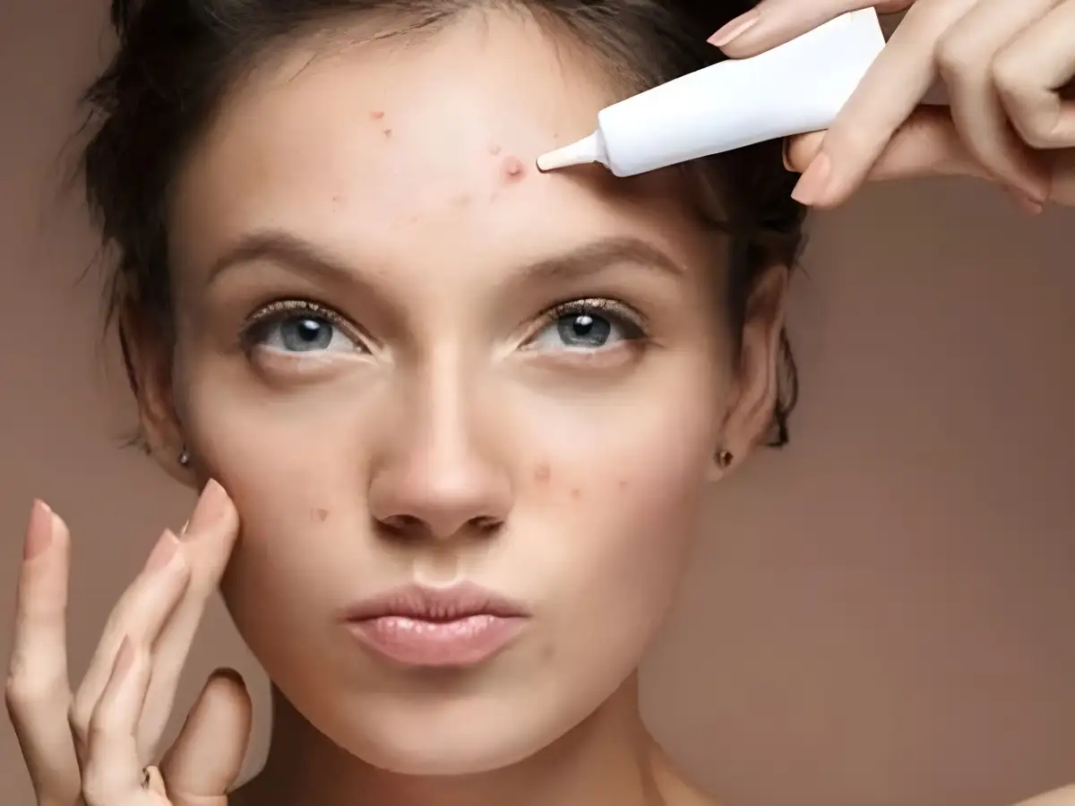 Nếu da bạn đang gặp vấn đề như mụn viêm hoặc thâm sau mụn, đây là lúc nên dùng sản phẩm đặc trị
