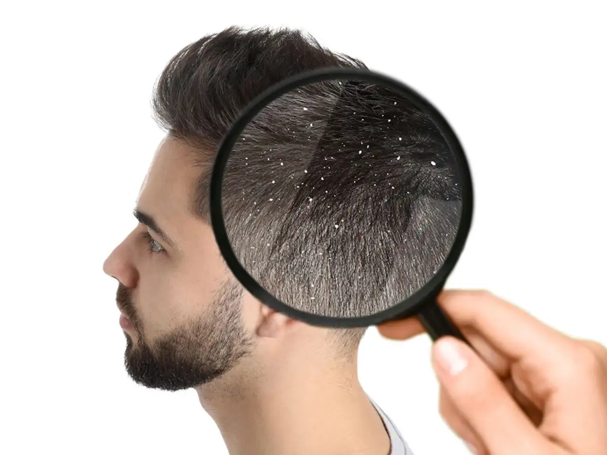 Tóc gàu có thể do nấm hoặc dị ứng với các sản phẩm chăm sóc tóc