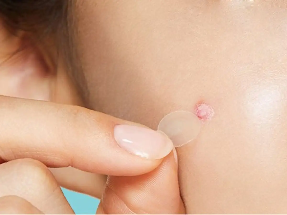 Miếng dán mụn thường làm từ hydrocolloid