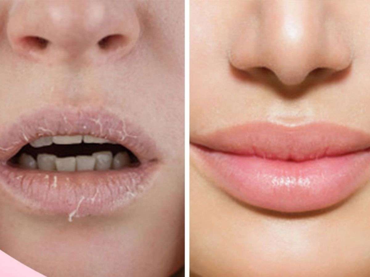 Môi Khô Nứt Nẻ Là Do Đâu? 