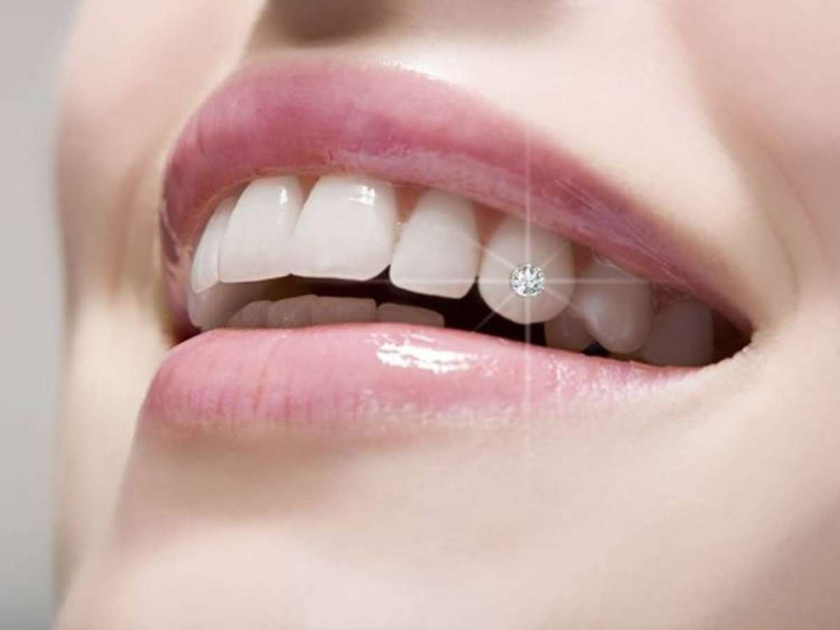 Đính đá răng bị bong thì bạn nên đến gặp bác sĩ