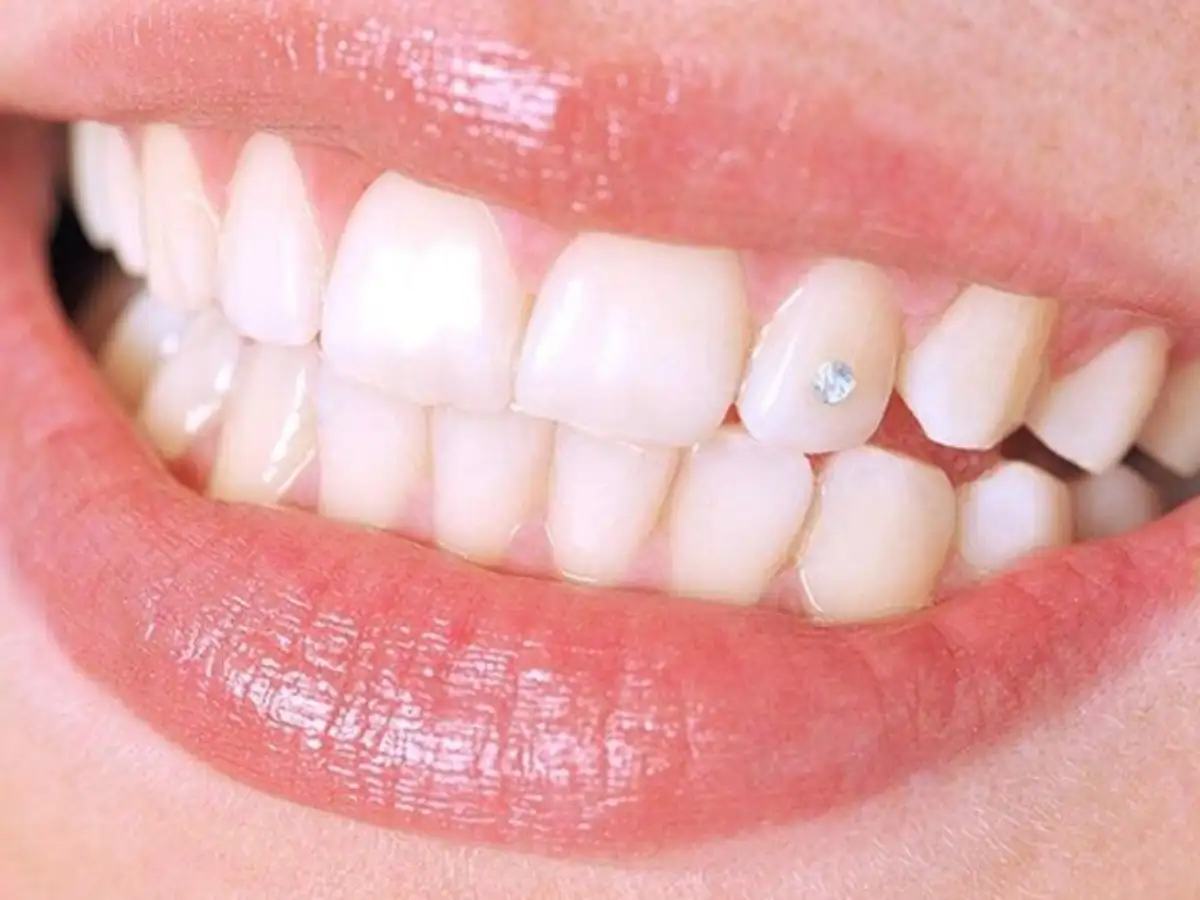 Đính đá răng là một thủ thuật thẩm mỹ nha khoa đơn giản 