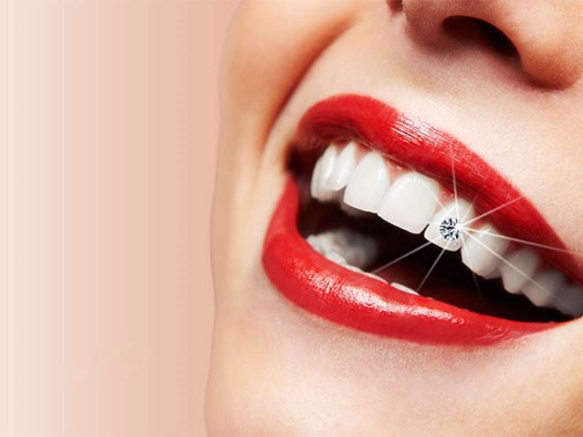 Giá thành của việc đính đá răng có thể có sự khác nhau tùy thuộc vào nhiều yếu tố 