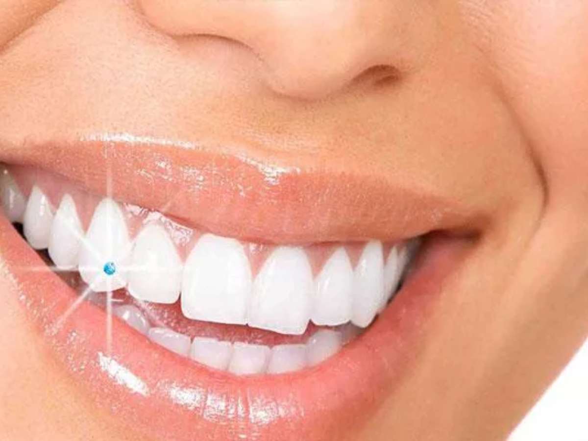 Việc đính đá răng sẽ an toàn nếu bạn chọn nha khoa uy tín 
