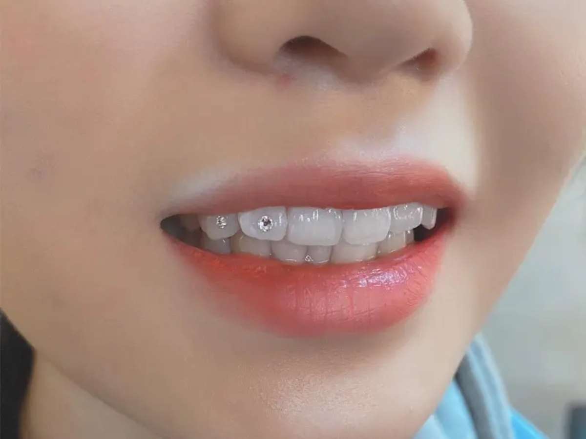Đối tượng có thể thực hiện đính đá răng