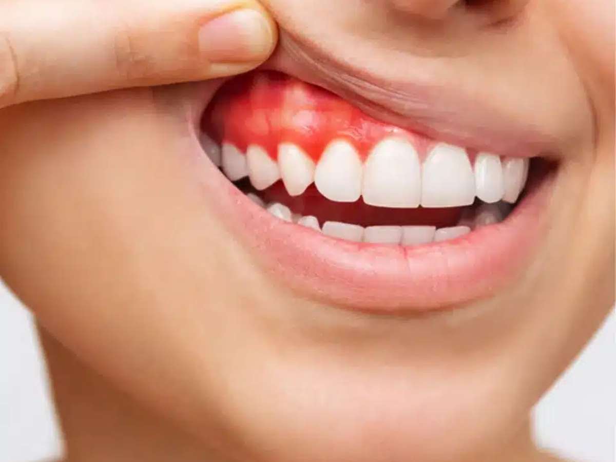 Một vài người không nên thực hiện đính đá răng 