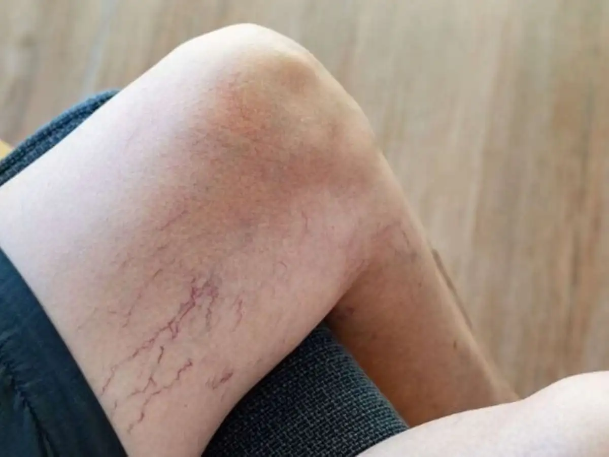Nam không mặc quần lót thường xuyên có thể gây tình trạng giãn tĩnh mạch