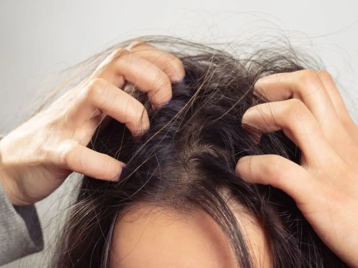 Da đầu có thể bị ngứa rát, mẩn đỏ, bong tróc khi nhuộm đen