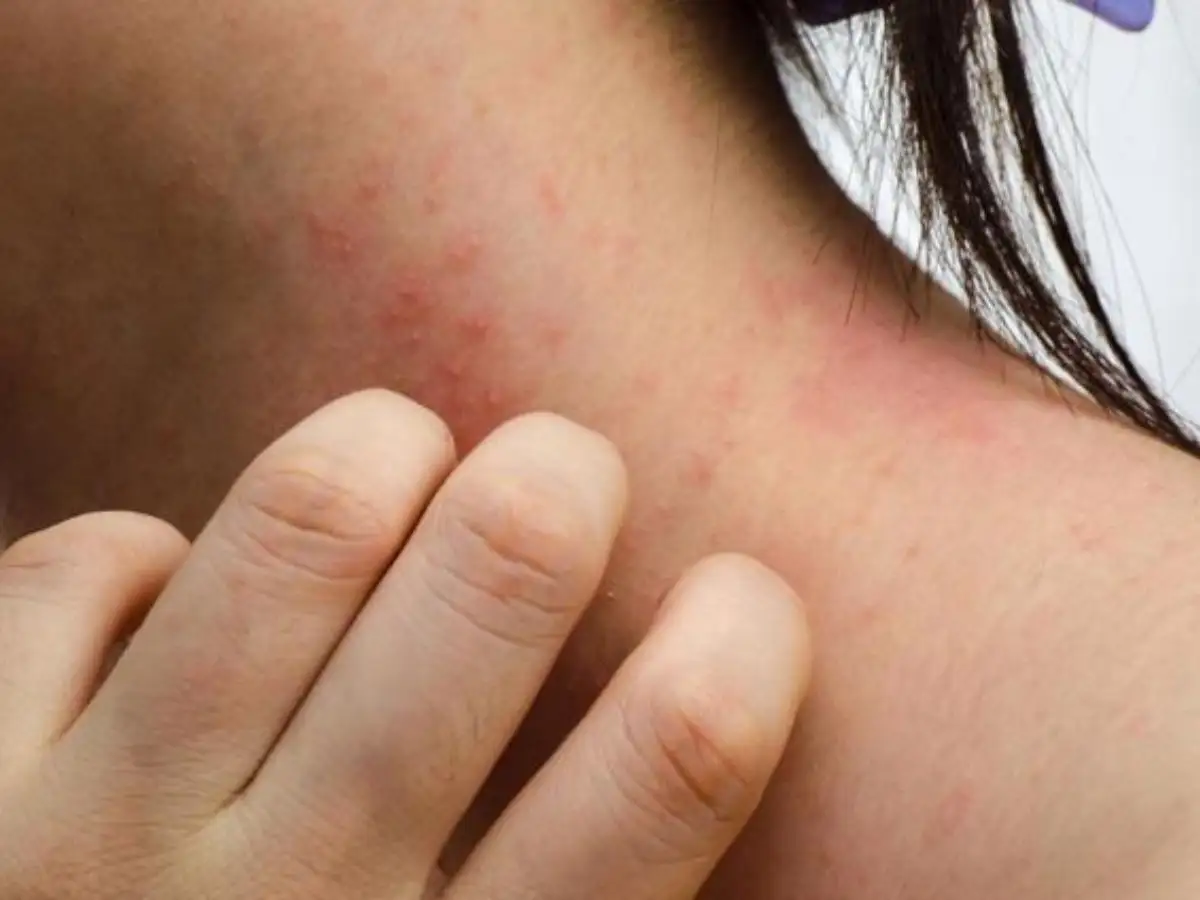 Nặng hơn là viêm da tiếp xúc dị ứng, thường liên quan đến PPD