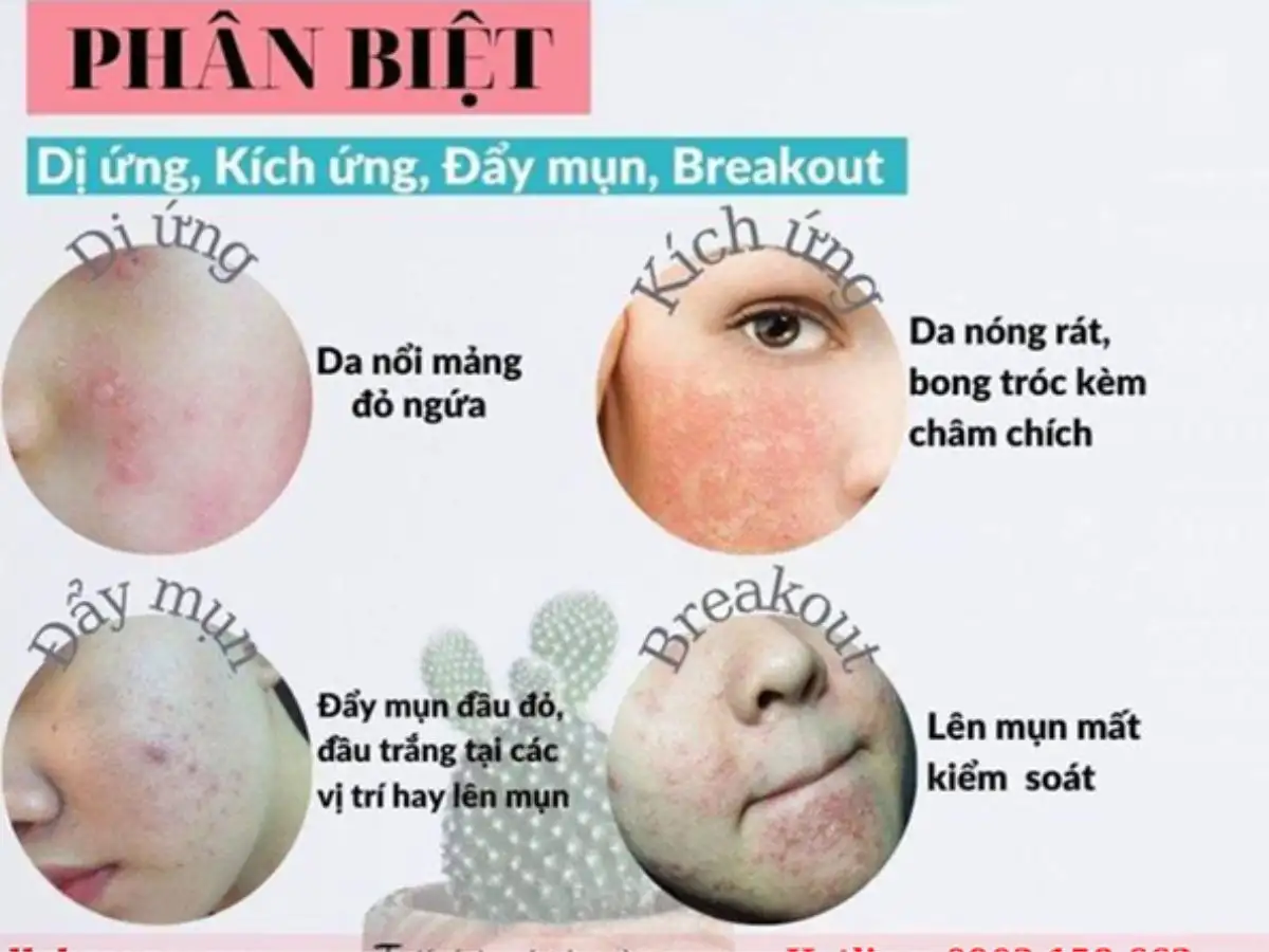 Đẩy mụn (Purging) và Kích ứng