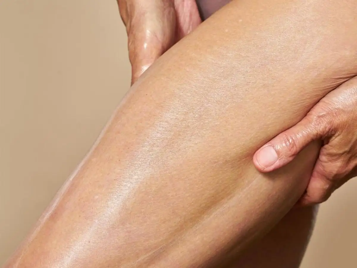Cách che sẹo ở chân khi mặc váy​ xịn như chuyên gia 