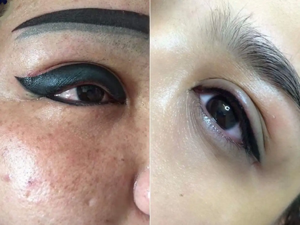 Phun mí mắt không đúng kỹ thuật có thể gây nên sự mất thẩm mỹ