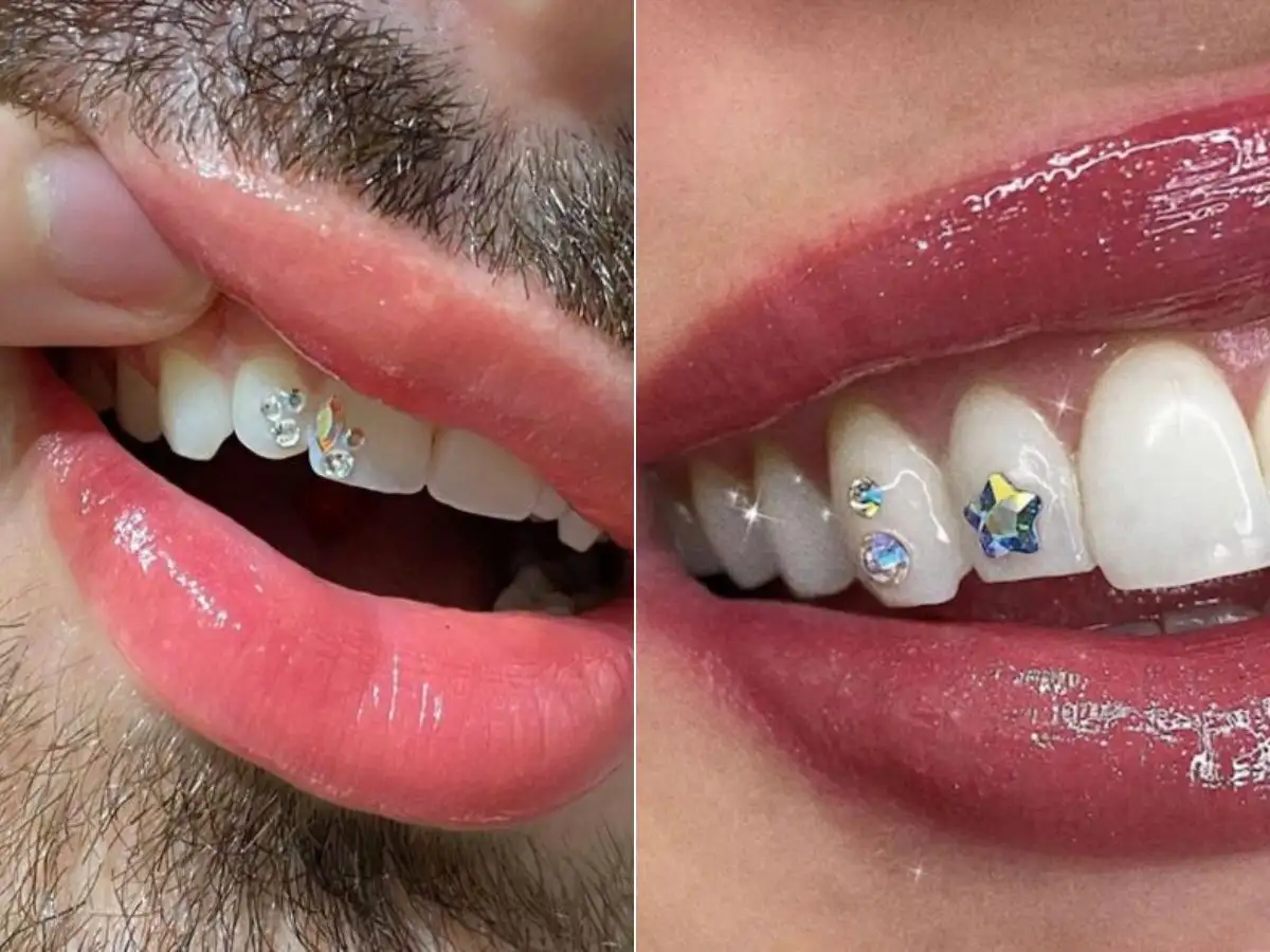 Nắm bắt kinh nghiệm chọn mua đá đính răng để tìm được viên đá ưng ý