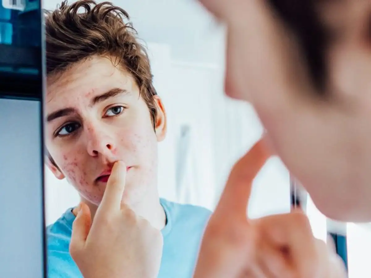 Da nam giới có những đặc điểm riêng hình thành lên mụn