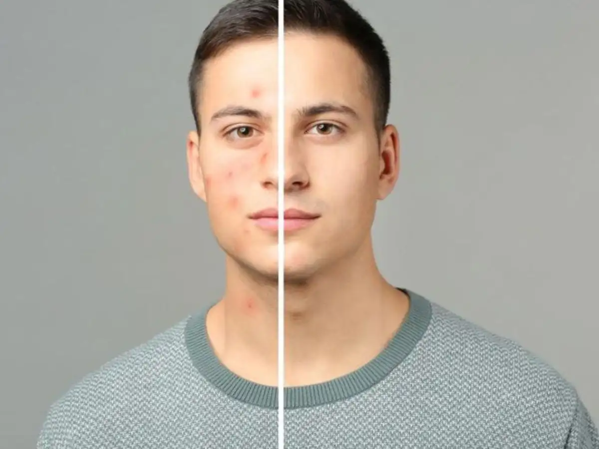 Toner trị mụn là một công cụ hữu ích trong việc cải thiện làn da mụn