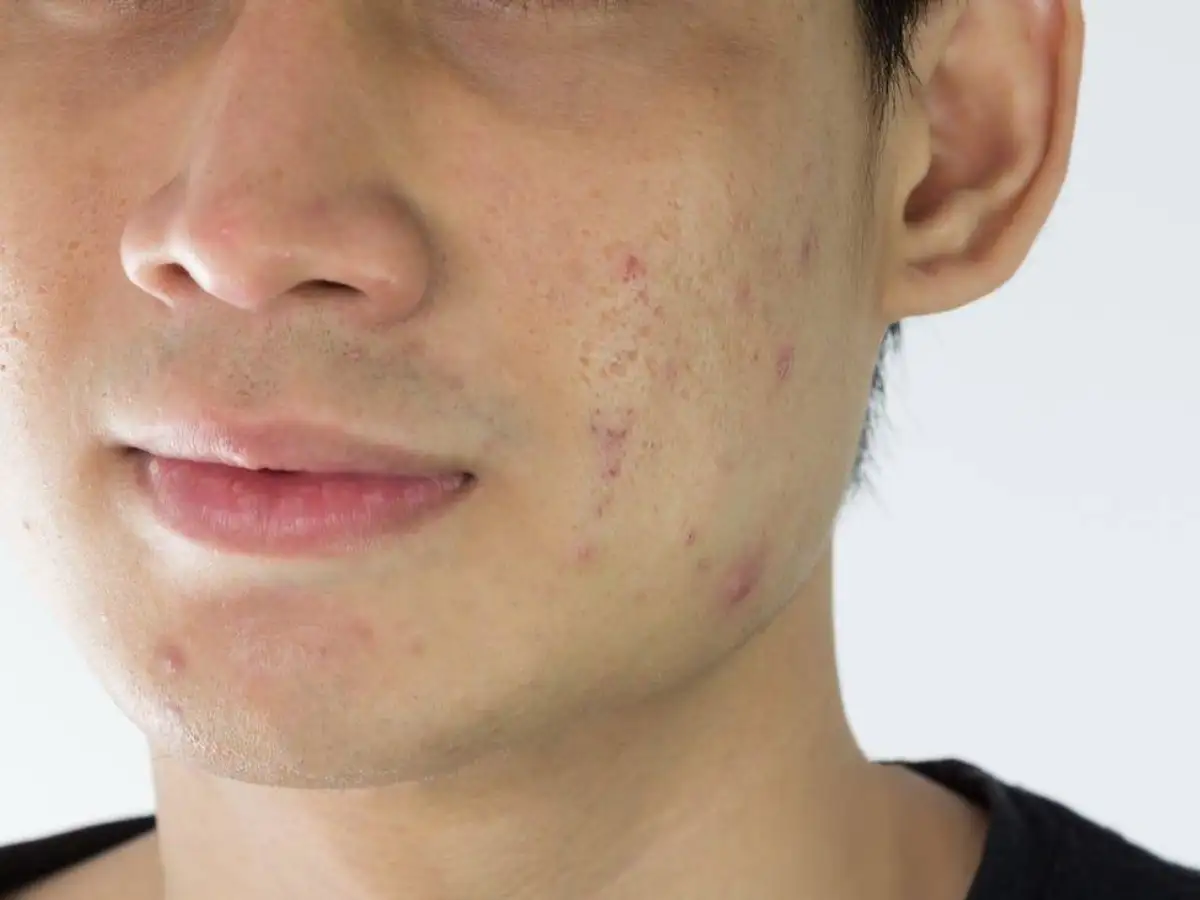 Một số đặc điểm mà làn da nam giới có thể gặp phải 