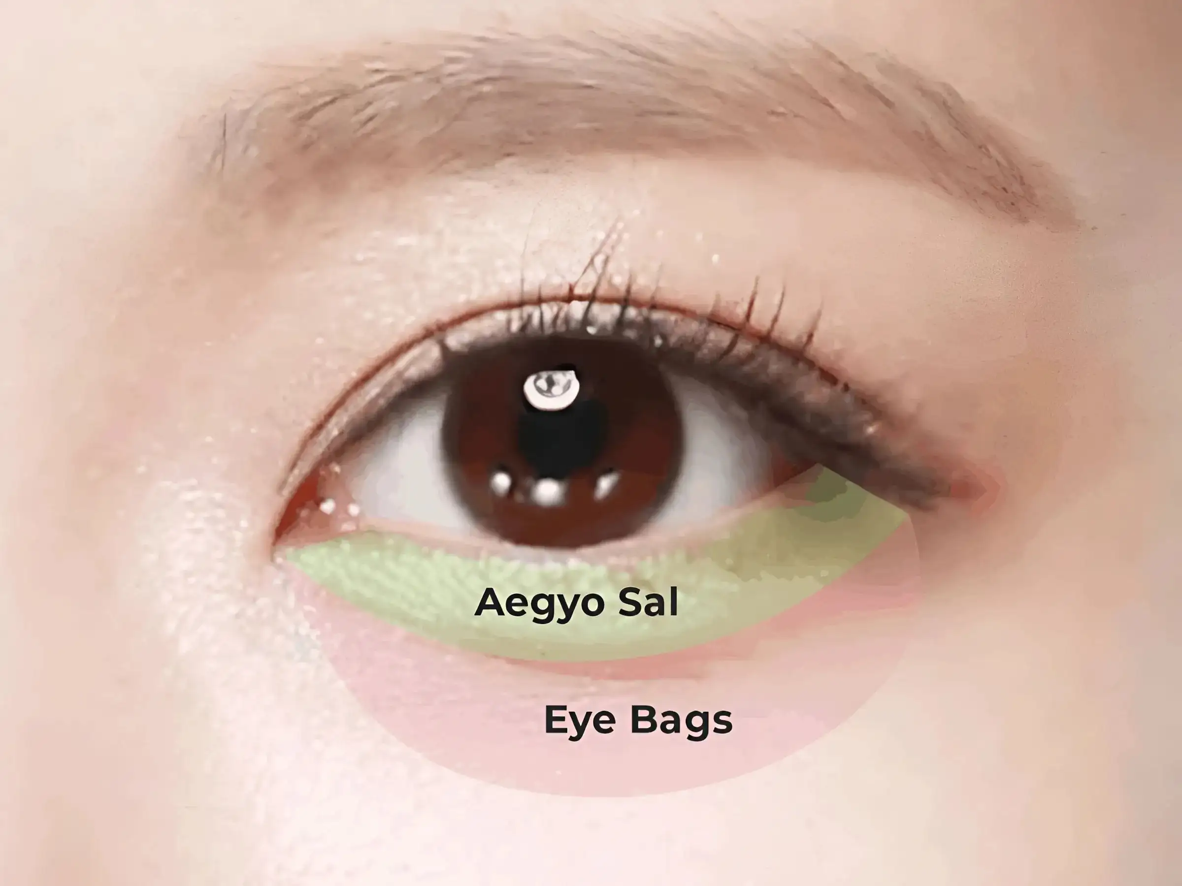 Bọng mắt tự nhiên (Aegyo Sal) là gì