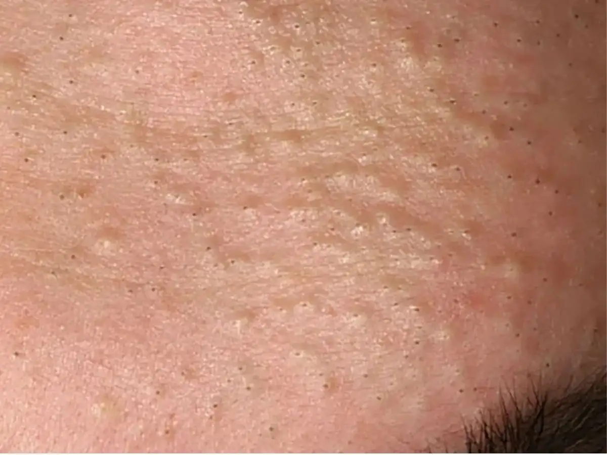 Những sai lầm phổ biến khi trị mụn ẩn