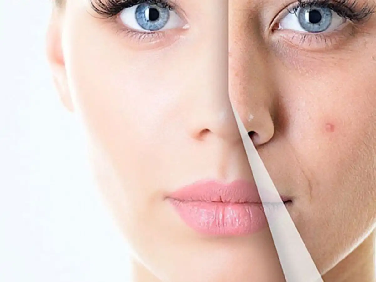 Trị mụn ẩn tại nhà bằng nguyên liệu thiên nhiên có hiệu quả không?
