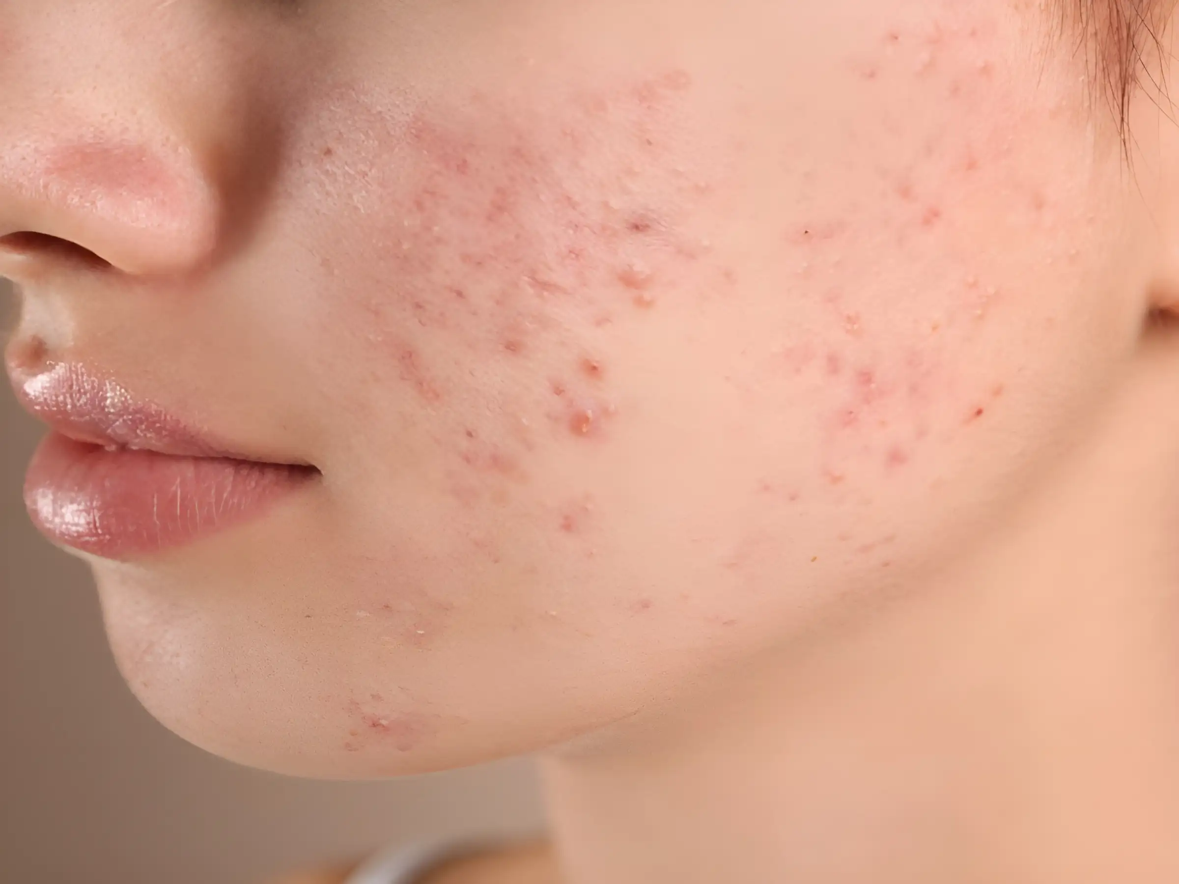 Trị mụn trứng cá tại nhà mất bao lâu thì hiệu quả?