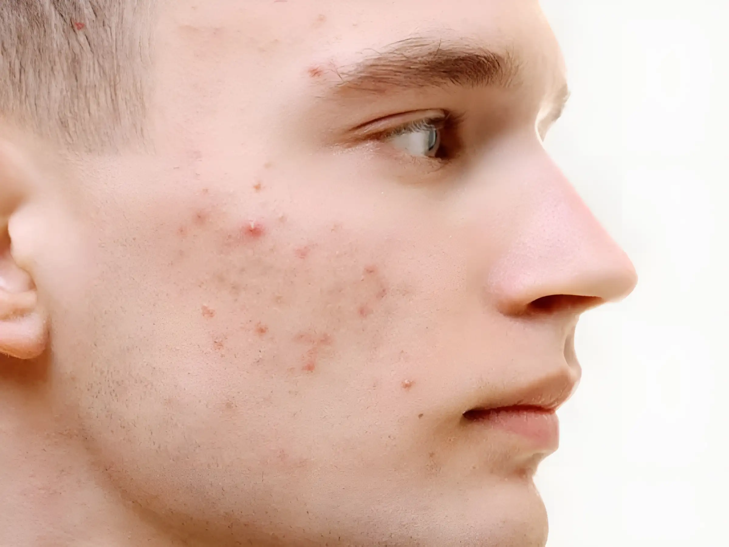 Cách trị mụn trứng cá cho nam giới có khác nữ giới không?