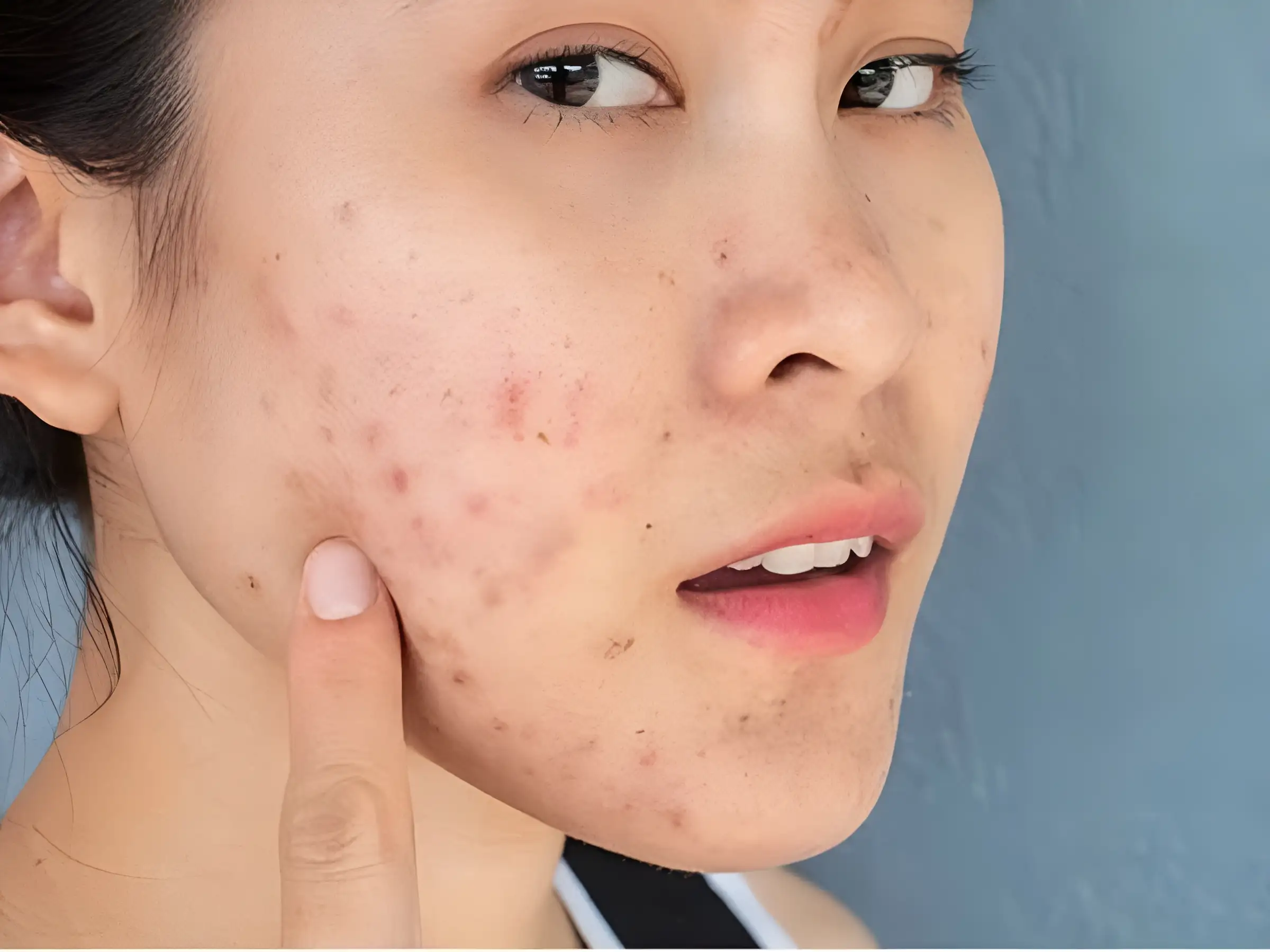 Có cần thay đổi chu trình skincare khi hết mụn không?