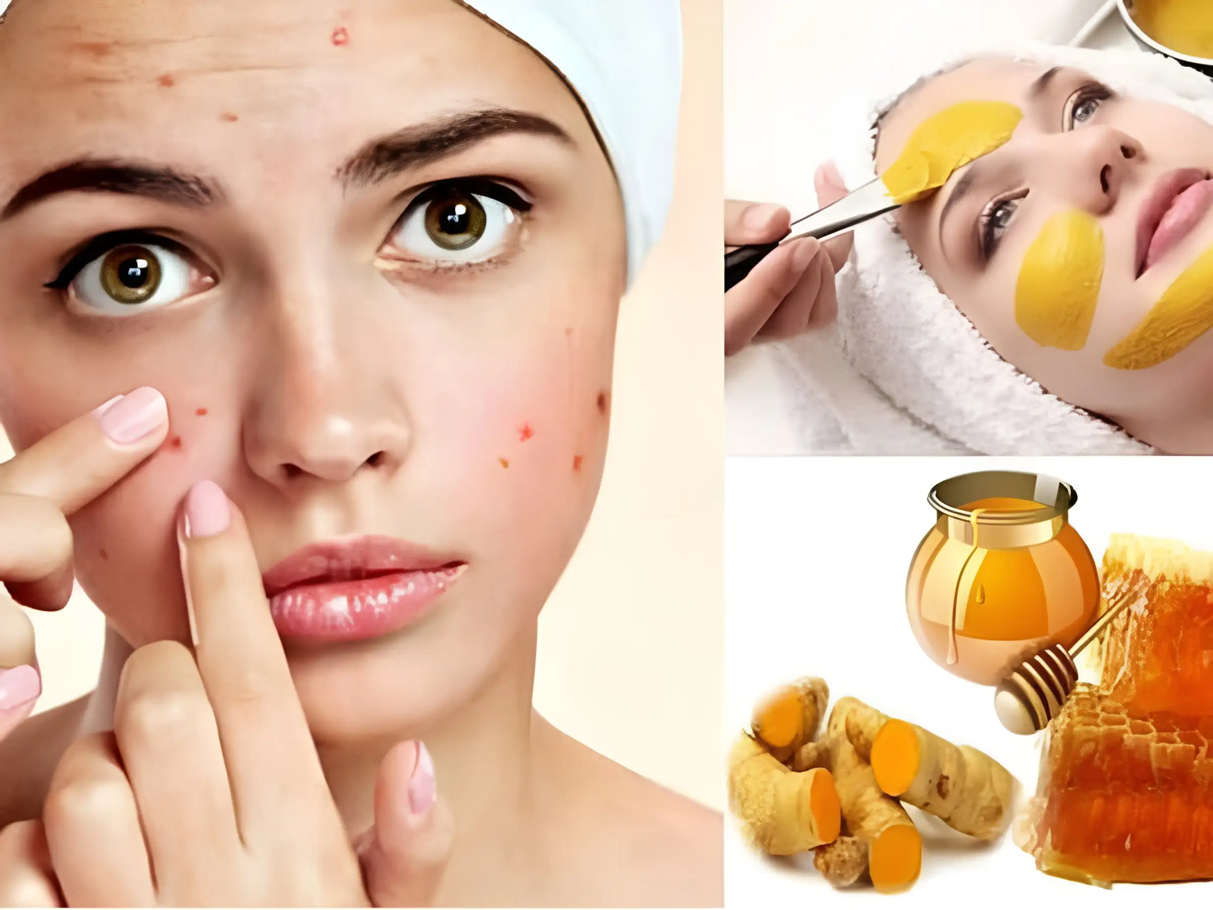 Công thức này được nhiều người tin dùng vì vừa trị mụn, vừa ngừa sẹo thâm khó chịu