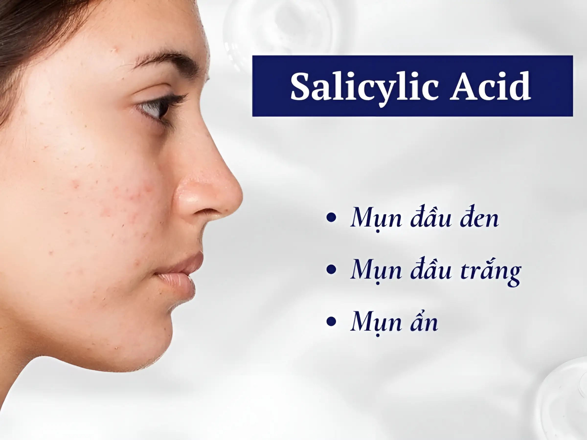 Salicylic Acid là vị cứu tinh cho ai hay bị mụn ẩn, mụn đầu đen hoặc lỗ chân lông to