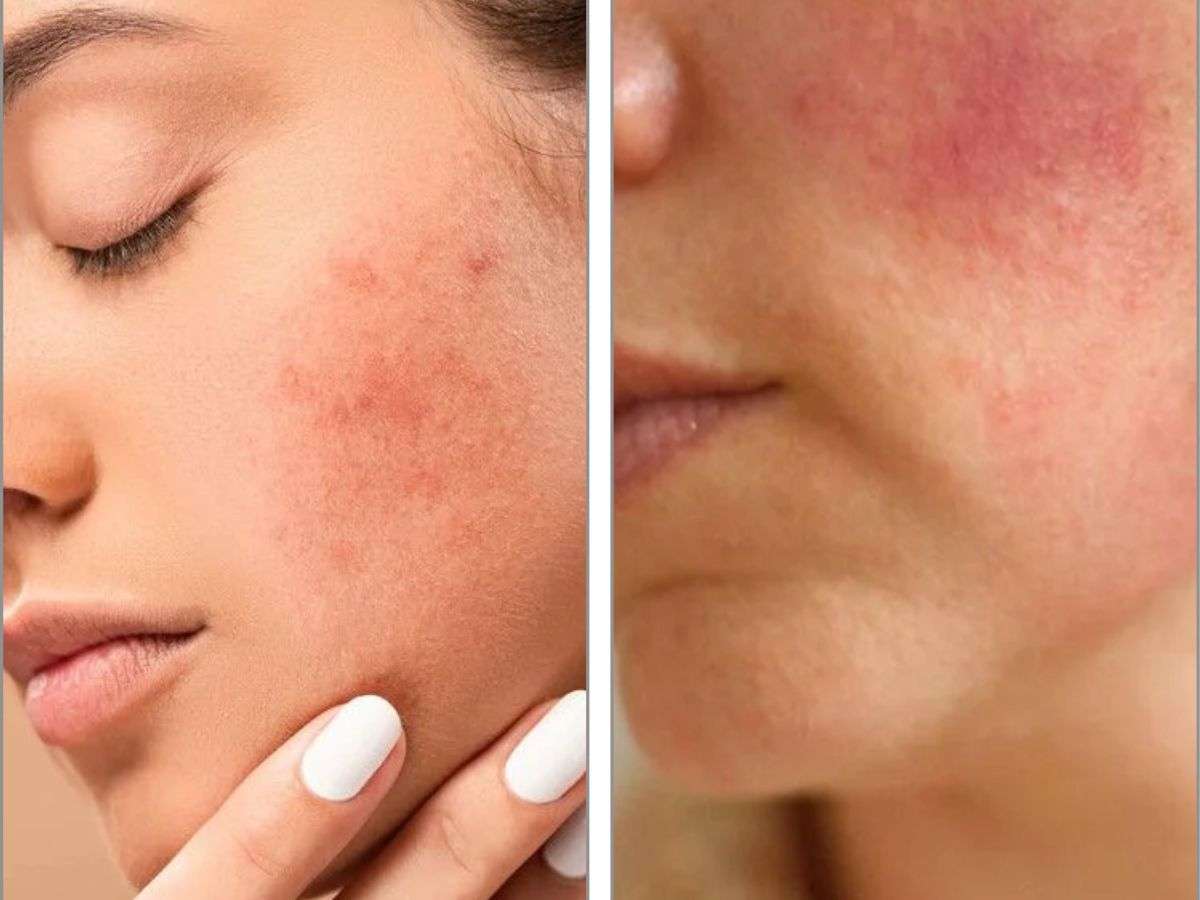 Phản ứng da với nắng