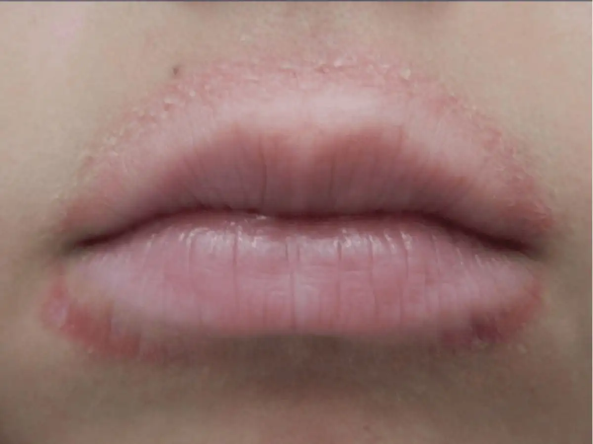 Dị ứng son môi là gì?