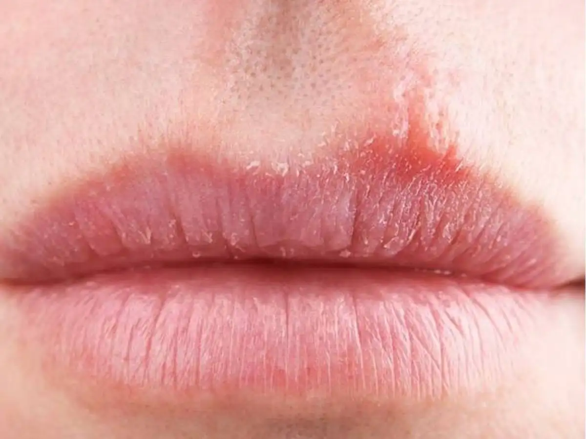 Dấu hiệu bị dị ứng son nhẹ nhàng